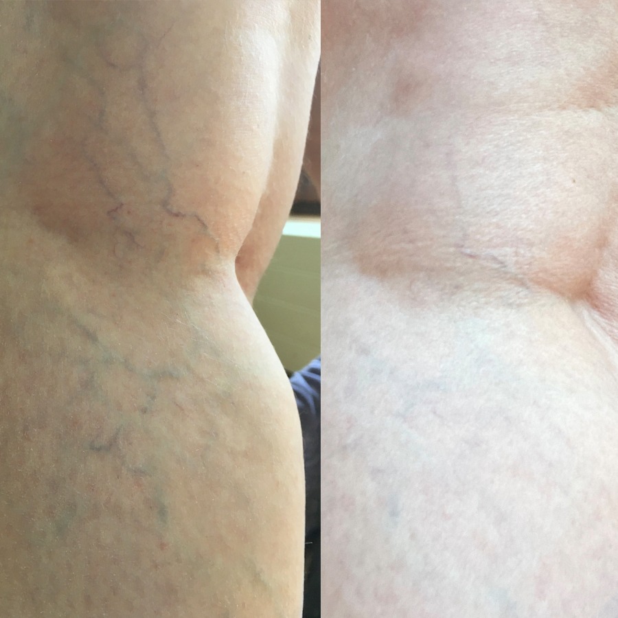 Besenreiser entfernen – starke Cellulite reduzieren und Bindegewebe festigen